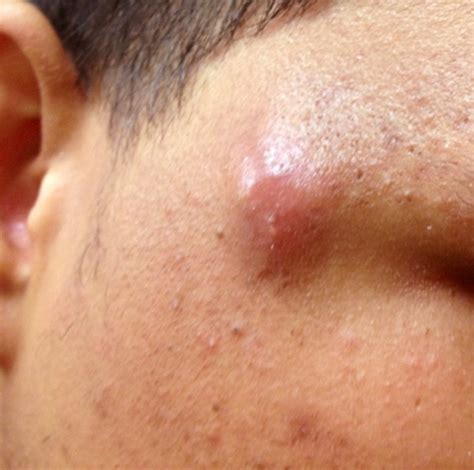 Sebaceous Cyst Causes, Symptoms, Treatment, and Pictures | HubPages