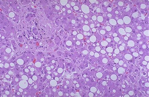 Hepatic Pathology