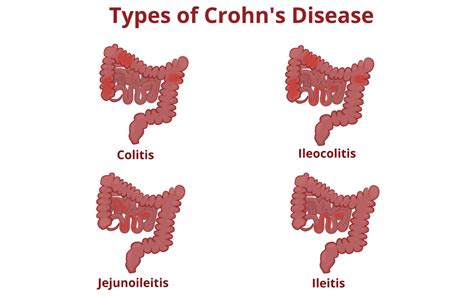 Crohn's Disease: Symptoms and Treatments Explained - Dr. Deetlefs