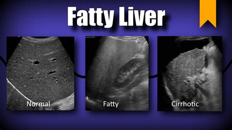 What Does An Ultrasound Of The Liver Show - ScienceHUB