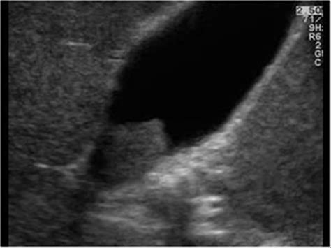 Abdomen and retroperitoneum | 1.2 Gallbladder and bile ducts : Case 1.2 ...