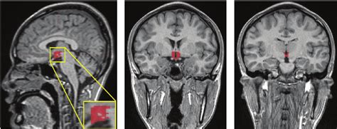 Sagittal and coronal views of the gray matter segment and hypothalamus ...