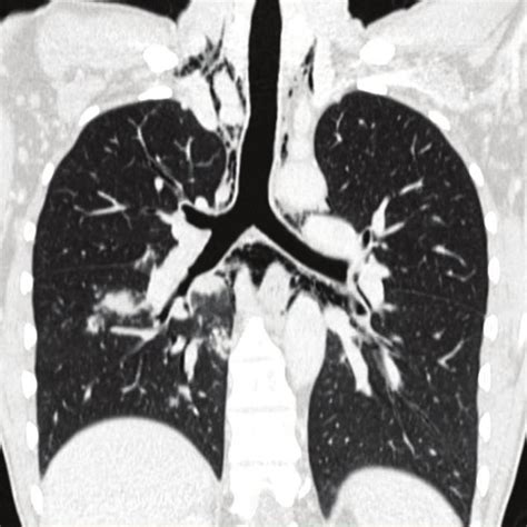 -Chest CT showing small centrilobular nodules with tree-in-bud... | Download Scientific Diagram