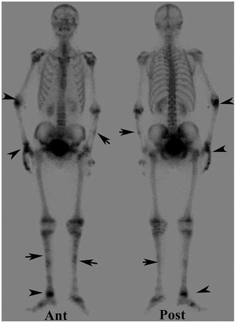 Abnormal Bone Scan