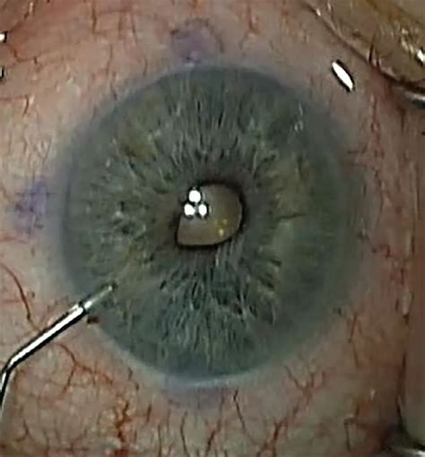 Ectropion uveae - American Academy of Ophthalmology