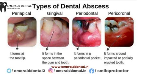 TYPES OF DENTAL ABSCESS - EMERALD DENTAL