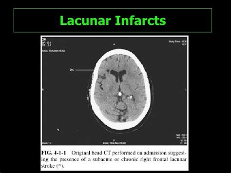 Small Lacunar Stroke