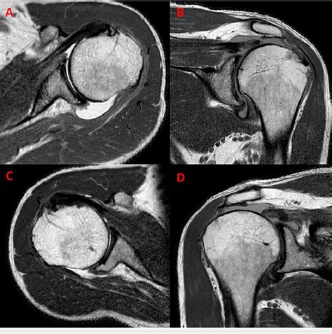 Bilateral shoulder MRI showing irreparable rotator cuff tear on axial... | Download Scientific ...