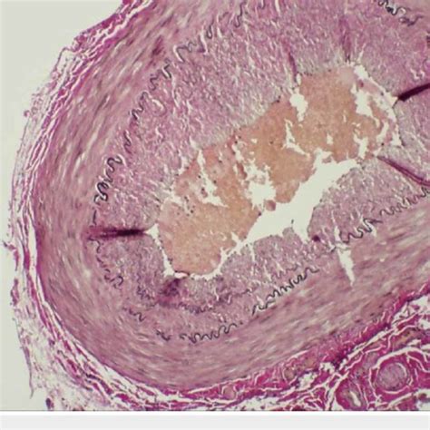 Temporal artery biopsy showing calcification of tunica media | Download ...