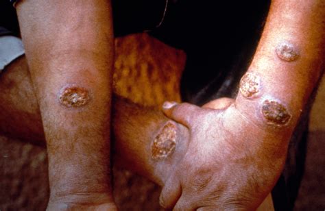 Mucocutaneous Leishmaniasis