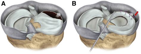 Editorial Commentary: Saucerization Is Superior to Total Meniscectomy in Patients With ...