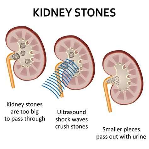 How To Help Break Down Kidney Stones - HealthyKidneyClub.com