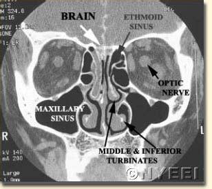 Coronal CT cisternogram showing CSF draining from the subarachnoid space through the roof of the ...