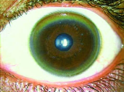 The Kayser-Fleischer ring around the periphery of the cornea caused by... | Download Scientific ...