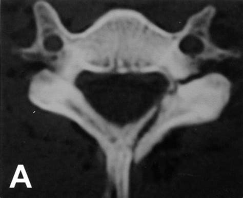 Cervical Lateral Mass Fracture Separation - Spine - Orthobullets