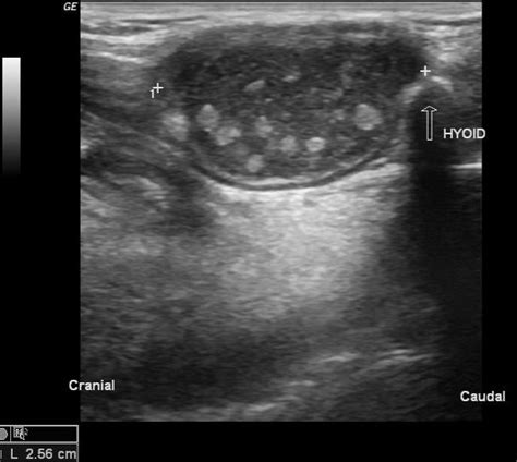 Ultrasound Of Thyroglossal Duct Cyst Ultrasound Of The Neck Detected A ...