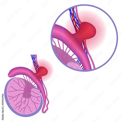 Spermatocele Anatomy