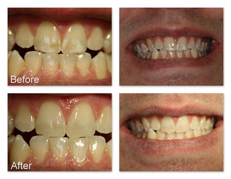 Removal of Superficial Tooth Stains Gallery – Dr. Jack M. Hosner, D.D.S.