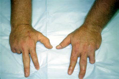 AMPUTATION, FINGER | Hand Surgery Resource