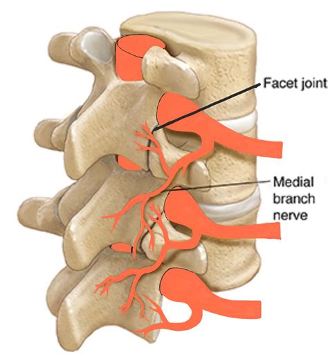 Medial Branch Blocks - Spines Dorset