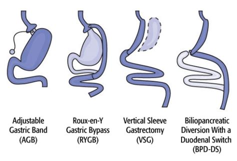 Bariatric Surgery Types