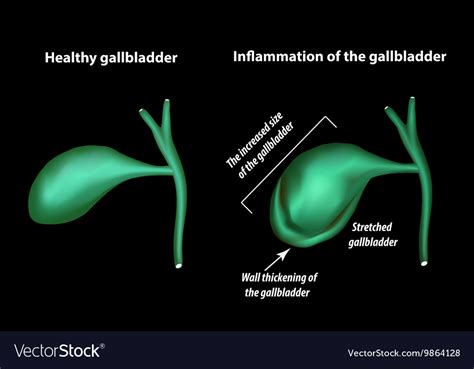 Symptoms gallbladder inflammation Royalty Free Vector Image