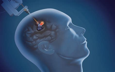 New Laser Option for Treatment of Epilepsy at UC San Diego Health