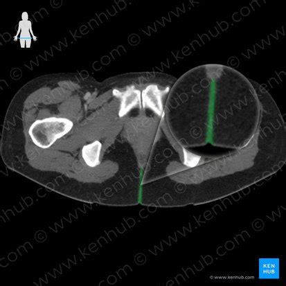 Intergluteal cleft: surface anatomy, location, features | Kenhub