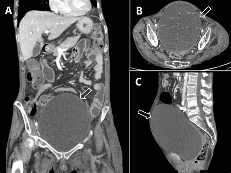 Cureus | Posing as Ascites: A Case Report on Neurogenic Lower Urinary ...