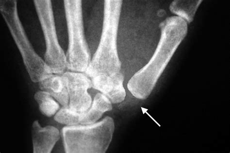 DISLOCATION, THUMB CARPOMETACARPAL (CMC) JOINT | Hand Surgery Resource