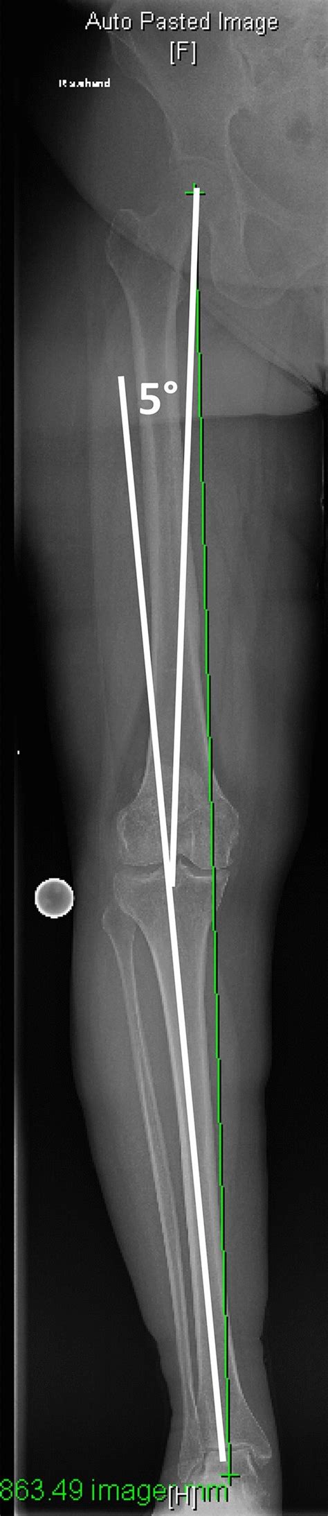 Calculation of the varus angle on whole leg X-ray between the ...