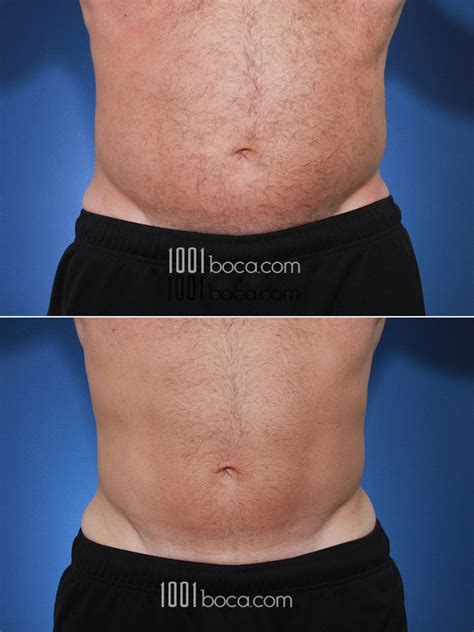 Coolsculpting Before and After Photos