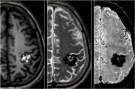 The Radiology Assistant : Brain - Epilepsy: Role of MRI