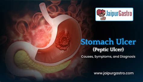 Stomach Ulcer (Peptic ulcer)