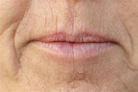 Smokers' Lines - How to Treat Upper Lip Lines and Wrinkles