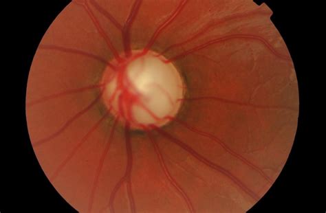 Glaucoma: una enfermedad ocular con tratamiento | Miranza