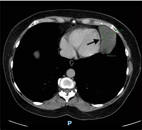 Figure 2 from A Large Pericardial Cyst in the Left Cardiophrenic ...