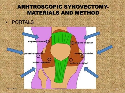 Role of arthroscopic synovectomy of knee joint in ra