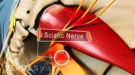 Types of Sciatic Nerve Pain