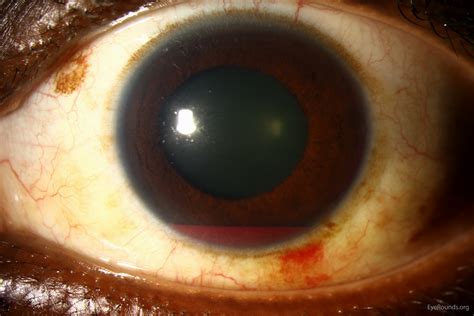 Atlas Entry - Traumatic hyphema