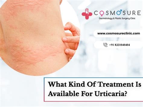 What Kind Of Treatment Is Available For Urticaria | Cosmosure Clinic