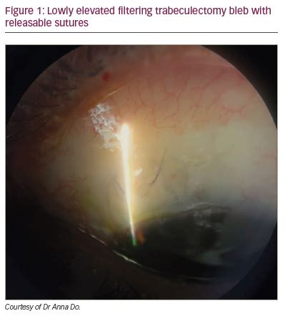 Bleb Management Following Trabeculectomy and Glaucoma Drainage Device Implantation ...