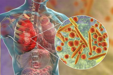 Macrolide-Resistant Mycoplasma pneumoniae Infection Rates High in Children, Western Pacific Region