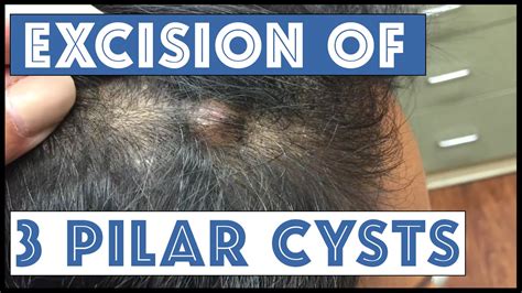 Another scalp with Three Pilar Cysts | Doovi