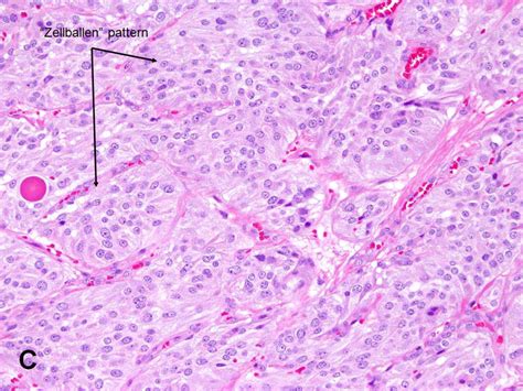 American Urological Association - Paraganglioma