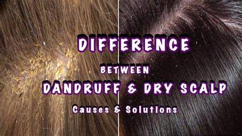 Nits Vs Dandruff How To Tell The Difference