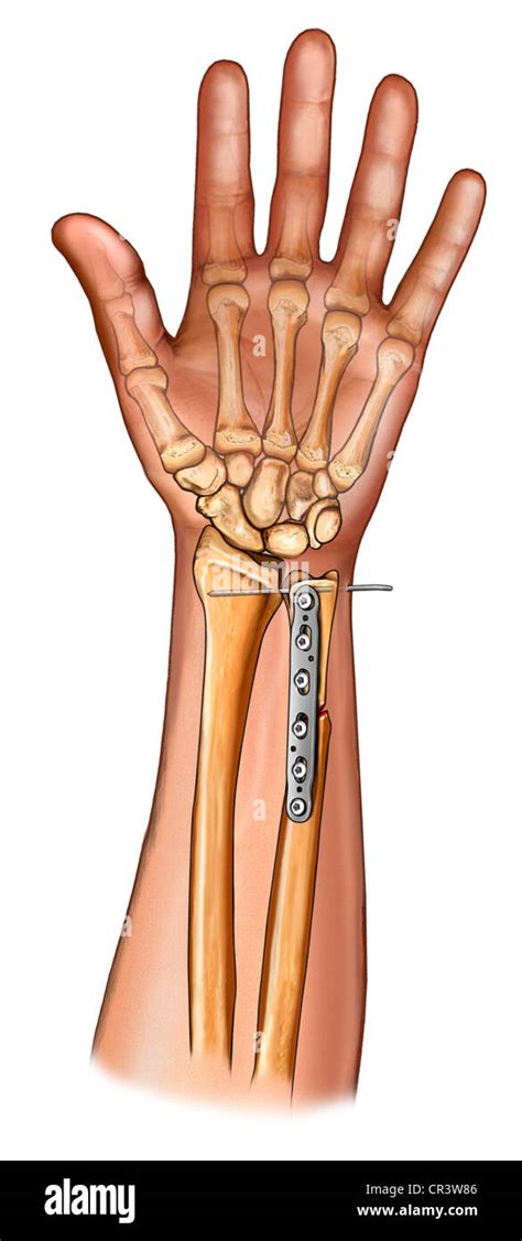 Distal Ulna Fracture Fixation Stock Photo: 48643510 - Alamy