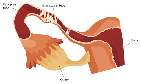 Blocked Fallopian Tube: Causes, Treatment & Fertility | AFGC