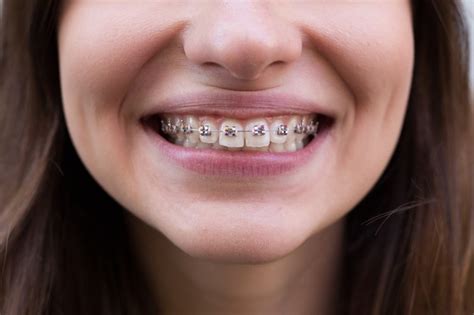 Popular Braces Colors for Girls and Boys - Is black a good braces color?