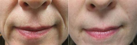 Smile lines (Juvederm Voluma) at Dr. Minuk's SkinClinic and Laser ...